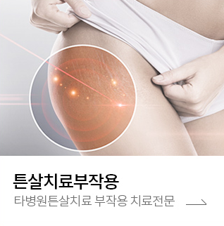 튼살치료부작용